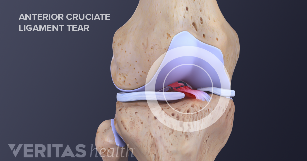 How To Tell If You Tore Your Acl Graft
