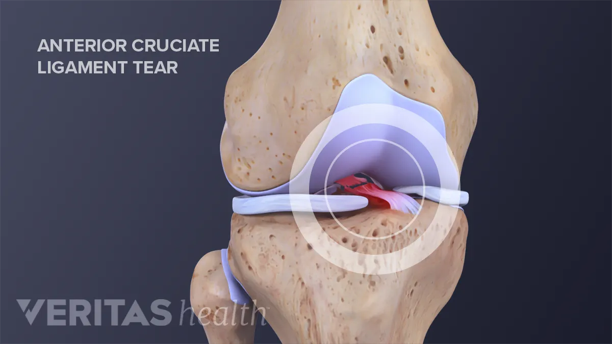 Anterior Cruciate Ligament (ACL) tear - Mediphany