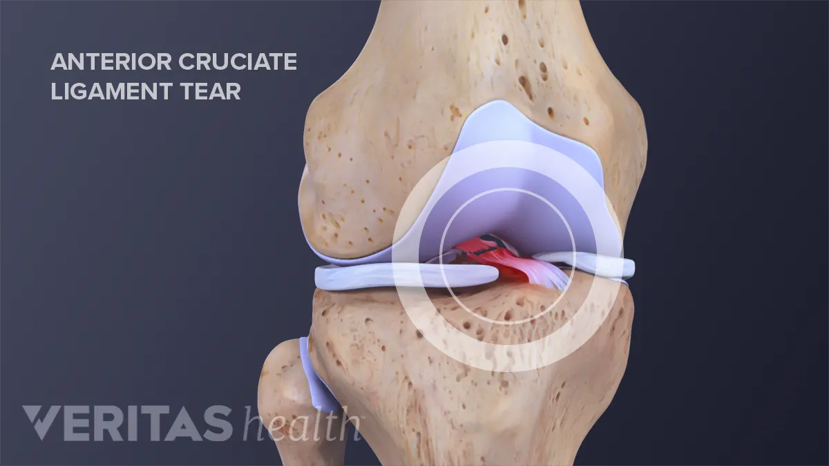 Anterior Cruciate Ligament (ACL) Tears