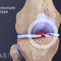 Torn Anterior Cruciate Ligament