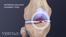 Anterior view of the knee joint with a torn ACL