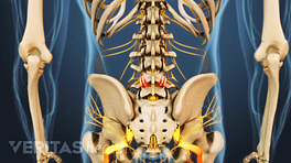 Posterior view of the pelvis with osteoarthritis in the lumbar spine.
