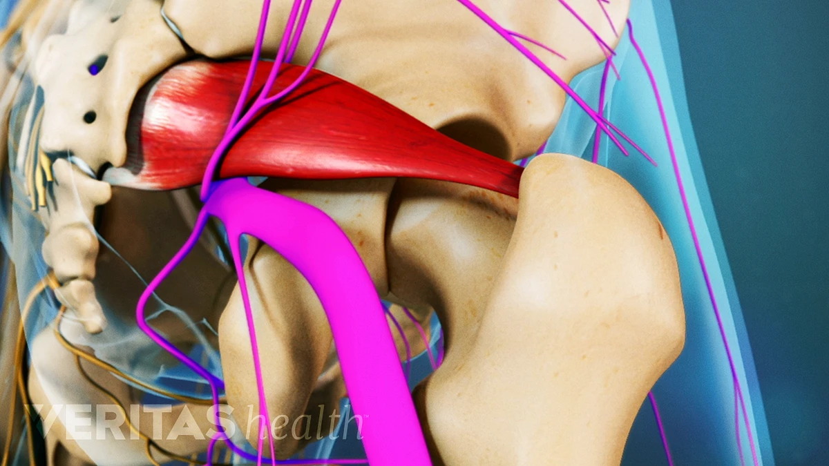 4 Effective Pain Relief Options for Piriformis Syndrome