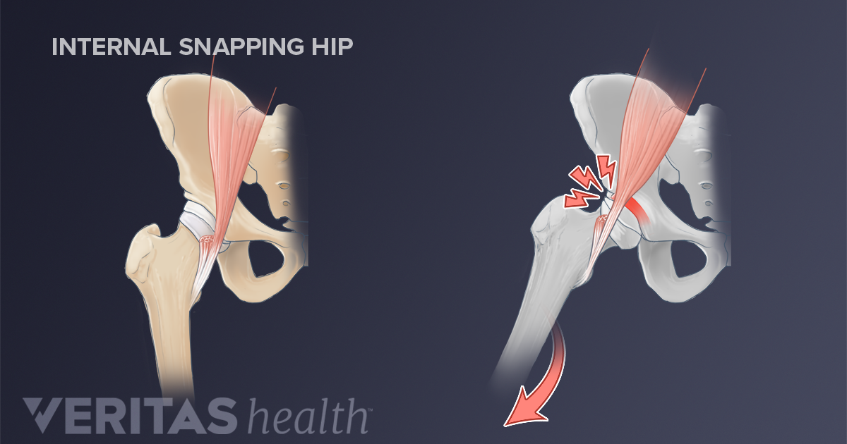 Pop, Click, Snap: Snapping Hip Syndrome
