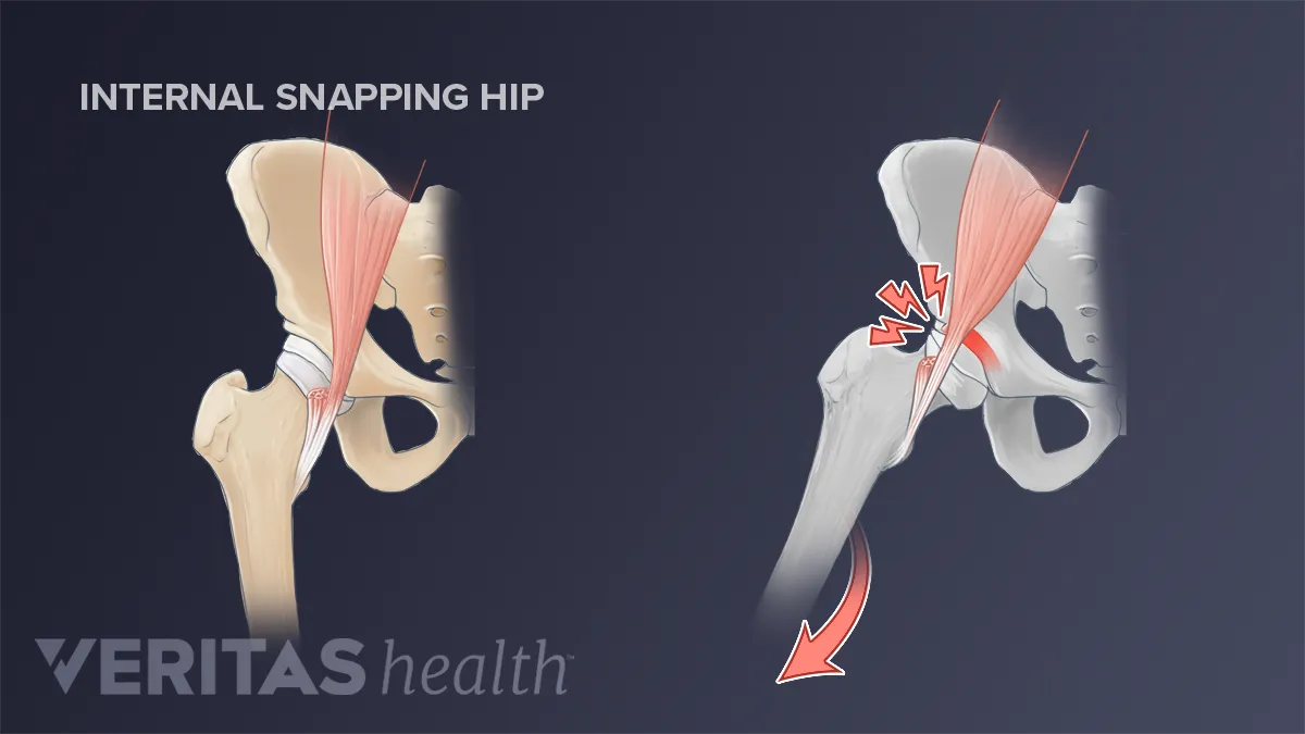 Pop, Click, Snap: Snapping Hip Syndrome