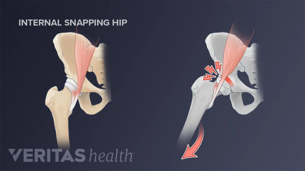 Snapping Hip Stretches