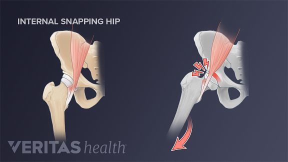 Side-by-side illustration of an internal snapping hip