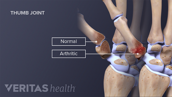 arthritis of the thumb