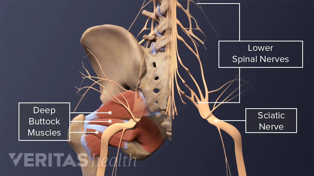 Sciatica Symptoms Including Back Pain and Leg Cramps
