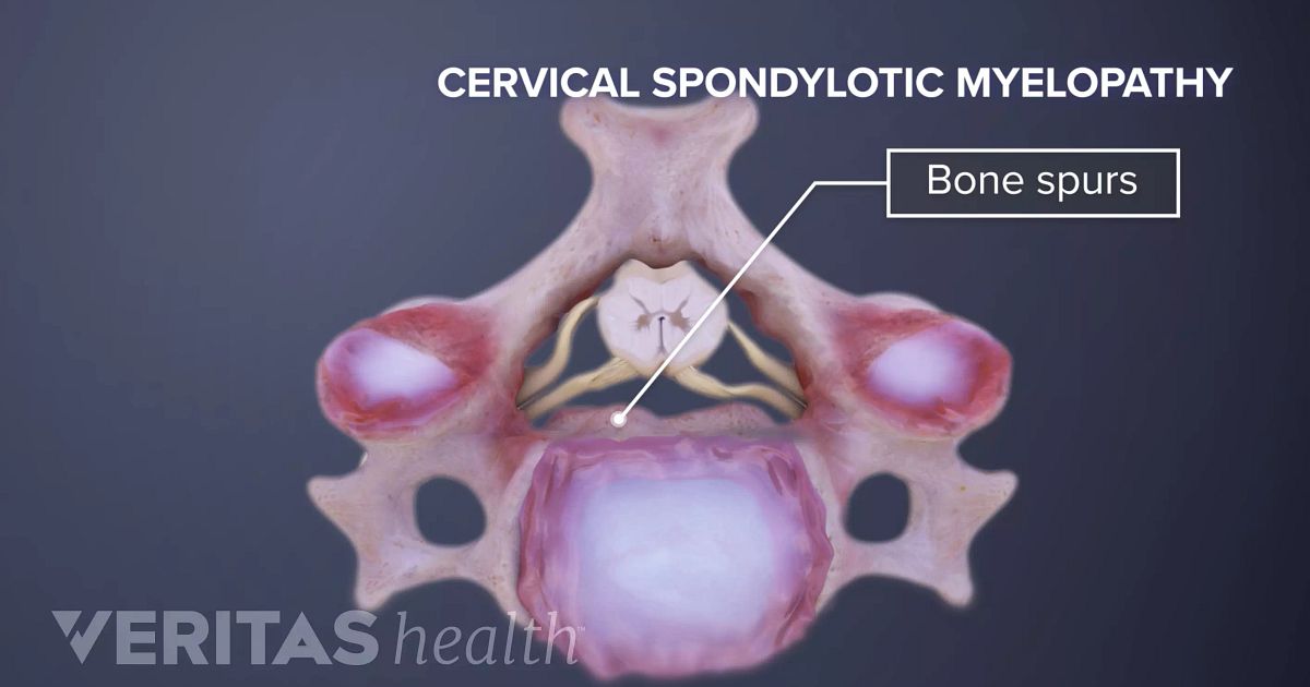 cervical-myelopathy-definition-back-pain-and-neck-pain-medical-glossary