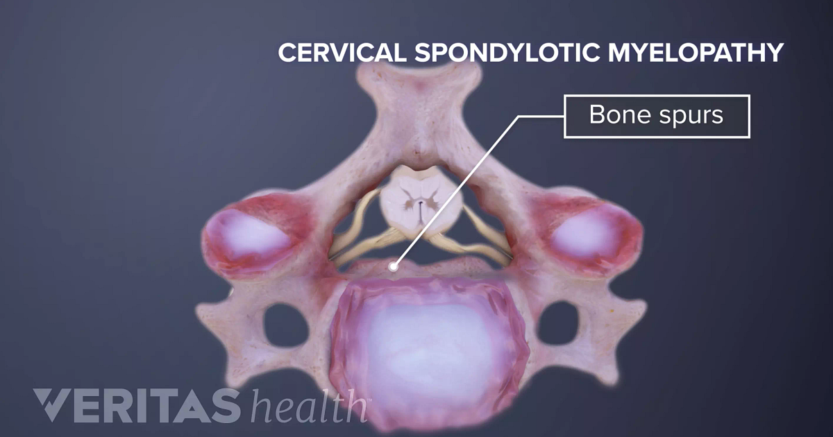 Cervical Myelopathy Definition | Back Pain And Neck Pain Medical Glossary