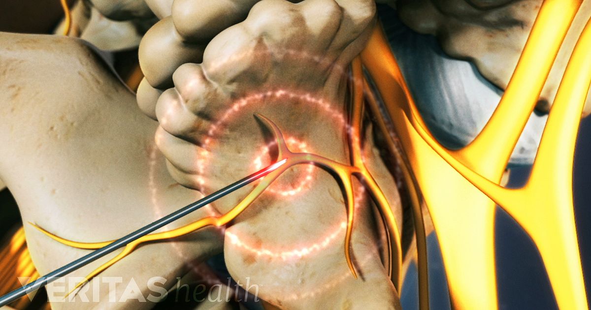 Radiofrequency Ablation Procedure