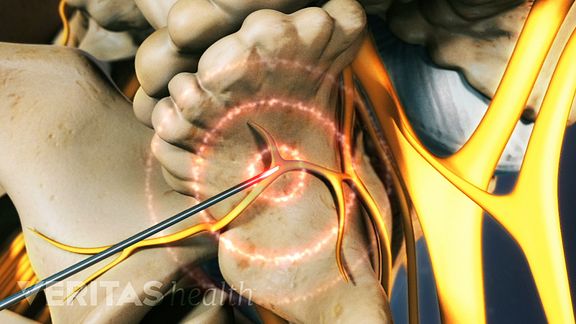 laser treatment for joint pain