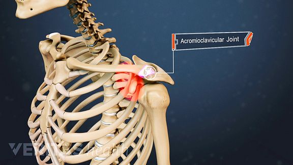 Impinged shoulder rheumatoid arthritis