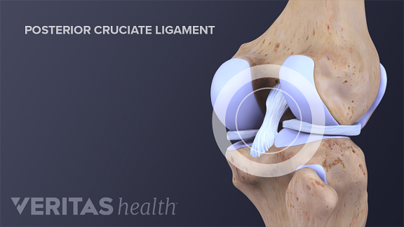 Posterior Cruciate Ligament (PCL) Definition | Sports Injury-Related ...