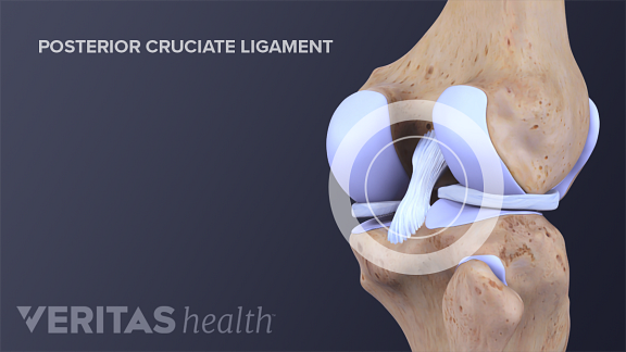 Anterior view of the posterior cruciate ligament