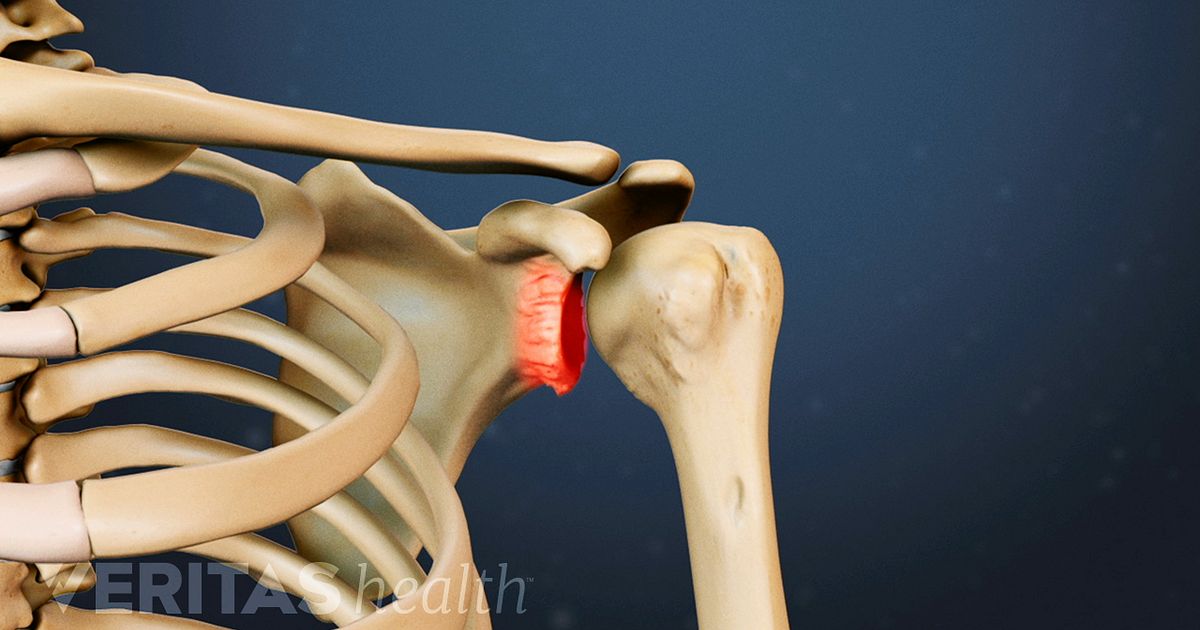 The Ins and Outs of a Reverse Shoulder Replacement The Ins and Outs of a Reverse Shoulder Replacement