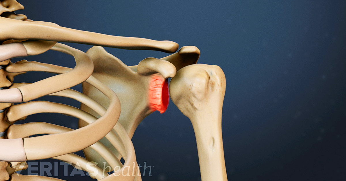 The Ins And Outs Of A Reverse Shoulder Replacement