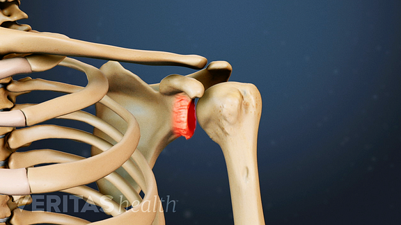Shoulder osteoarthritis is a degenerative joint disease that involves two primary processes.