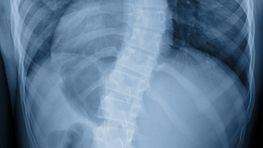 Xray of spine with scoliosis.