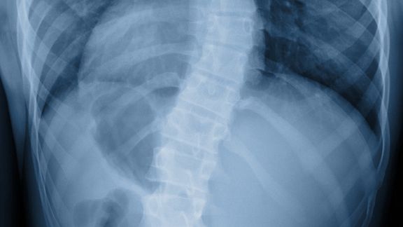 Scoliosis film x-ray show spinal bend in teenaged patient