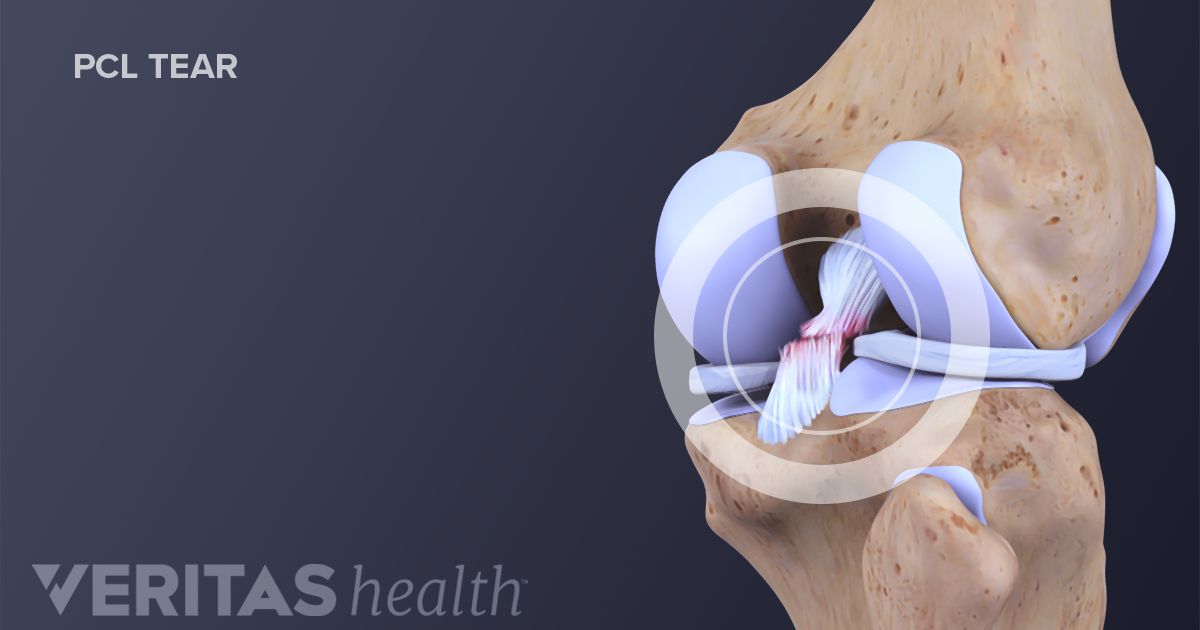 Pcl Posterior Cruciate Ligament Injury