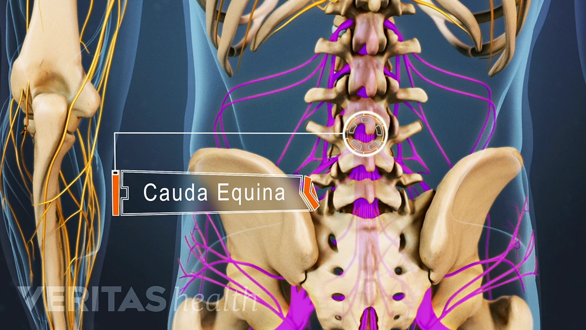 When Sciatica Pain Is a Medical Emergency