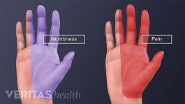 Two hands, with half of each hand highlighted. One shows hand pain, the other numbness