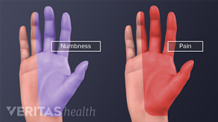 Getting the Right Diagnosis for Numb Fingers Getting the Right Diagnosis for Numb Fingers
