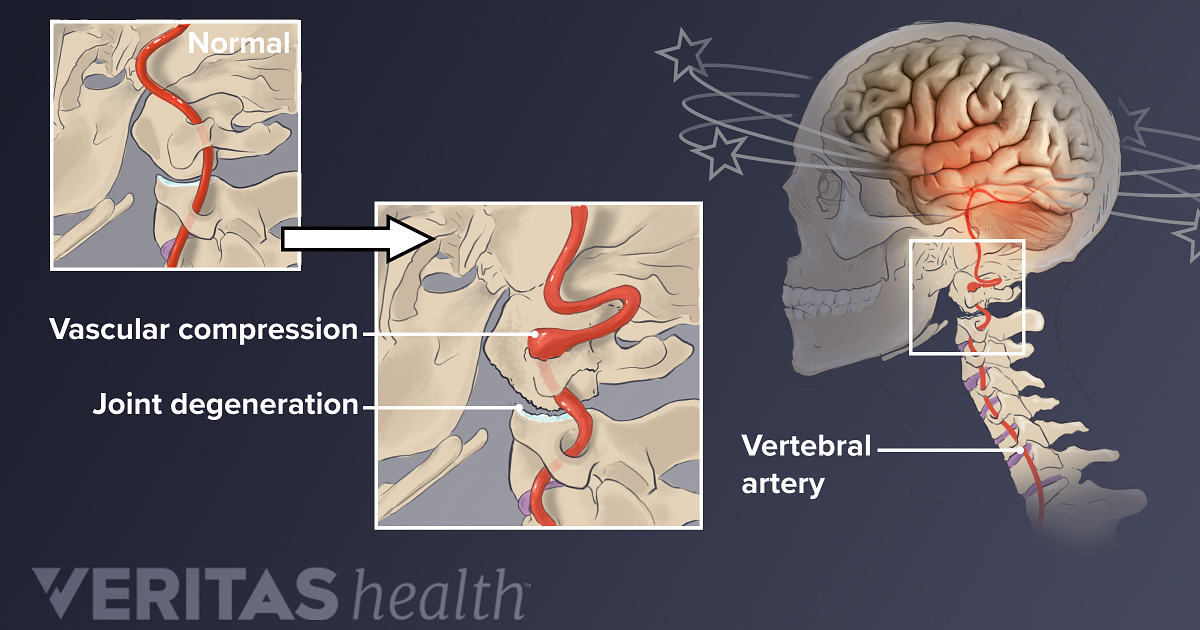 What Causes Neck Pain And Dizziness 