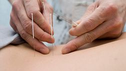 Closeup of acupuncture needles