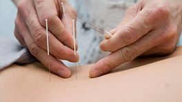Hand placing an acupuncture needles into the skin of the lower back