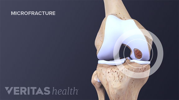 Illustration of microfractures in the knee joint