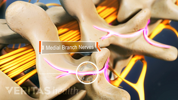 Medial Nerve Branch Blocks Help Diagnose Facet Joint Pain
