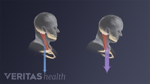 Illustration comparing neutral head posture and forward head tilt