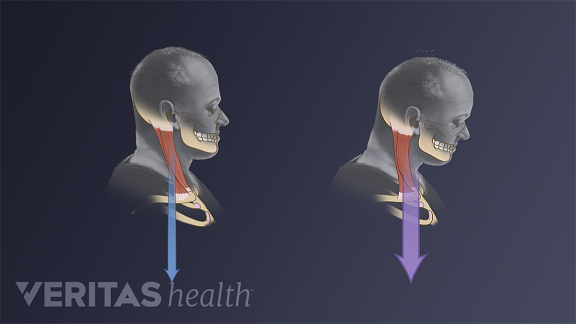 Medical illustration of proper head posture and forward head posture