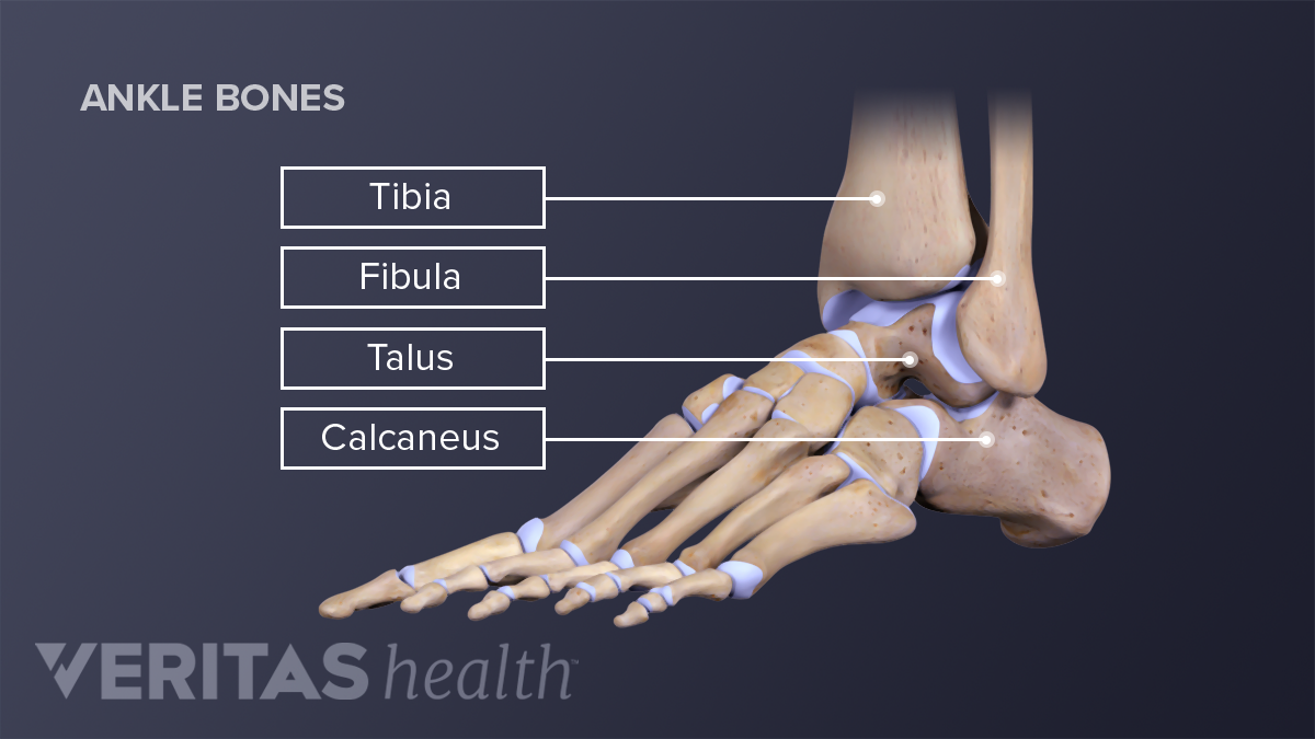 a calcaneus osteoarthritis)