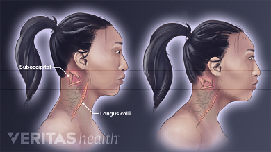 Forward Head Posture S Effect On Neck Muscles Forward Head Posture S Effect On Neck Muscles