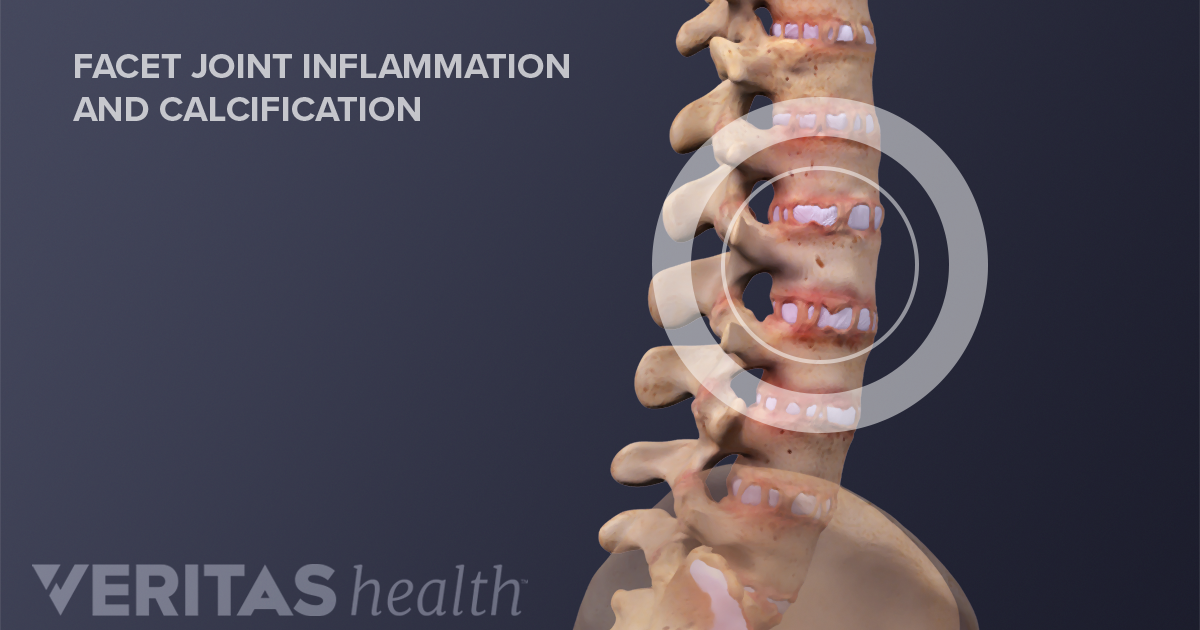 Types Of Ankylosing Spondylitis