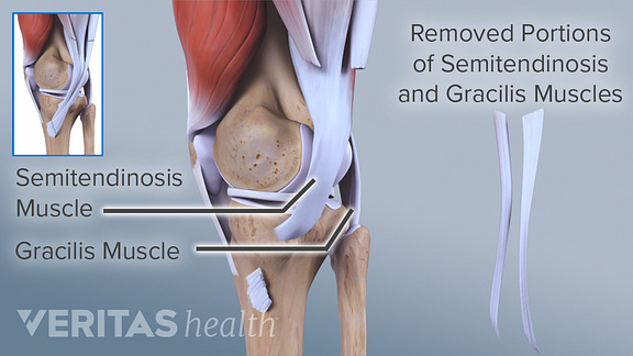 ACL Surgical Repair