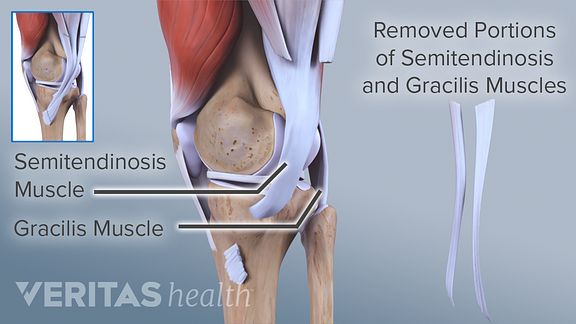 Acl Surgical Repair