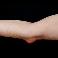 Profile view of the arm showing a olecranon bursitis.