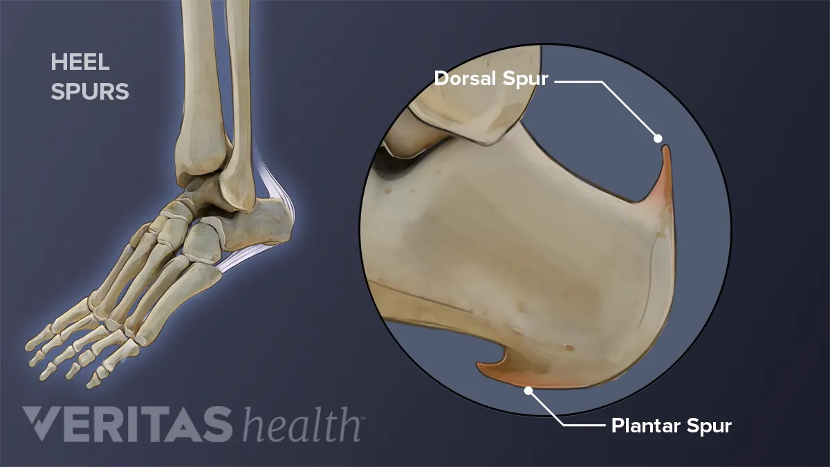 What To Expect From Heel Spur Surgery - The Orthopaedic Foot & Ankle Center-gemektower.com.vn