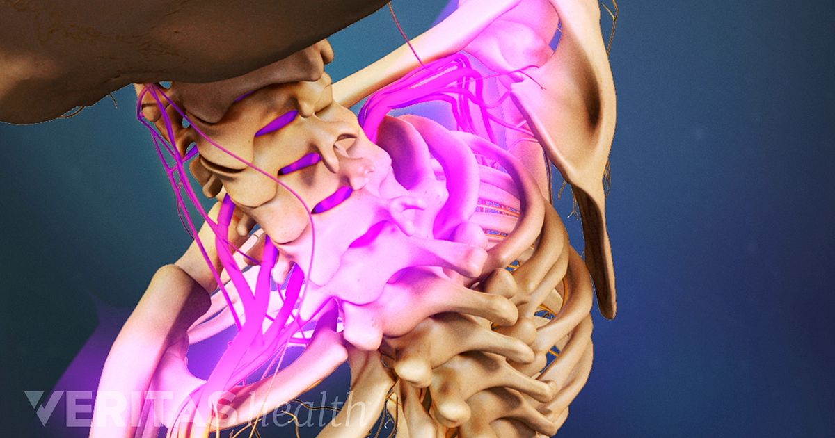 Neck Pain From Thoracic Outlet Syndrome