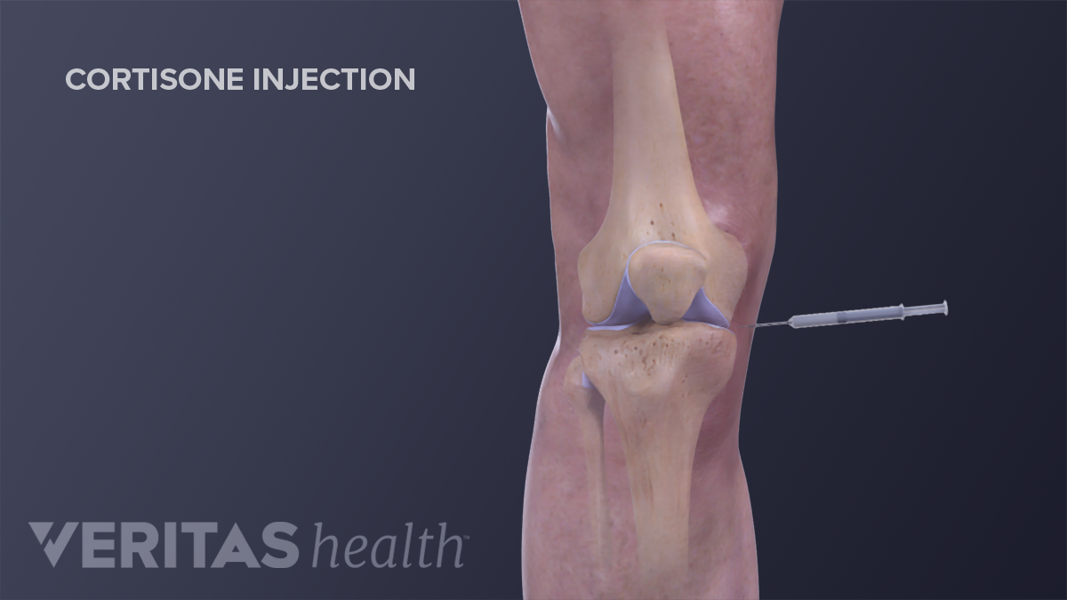 Steroid Injection Into Knee Side Effects