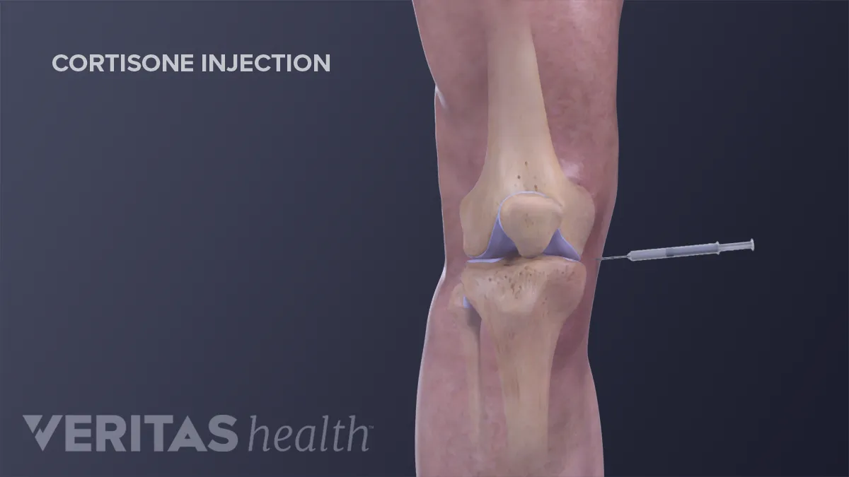 Side Effects Of Steroid Injections Into Joints