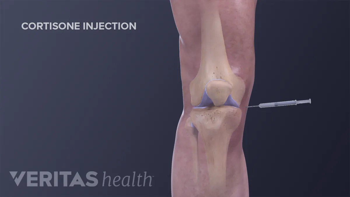 Cortisone Injections (Steroid Injections)