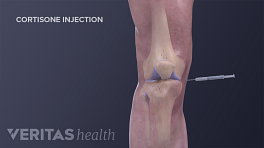 Illustration of cortisone injection into the knee for osteoarthritis treatment