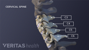 Neck Cracking and Grinding: What Does It Mean?