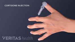 Cortisone injection in the pointer finger